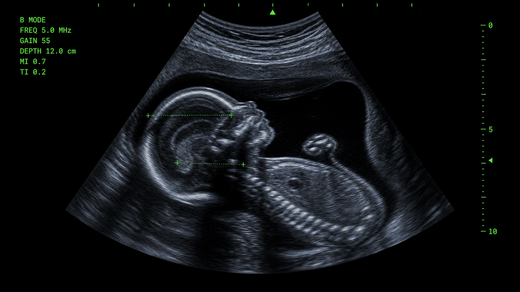 Sample obstetric ultrasound preview with diagnostic markers